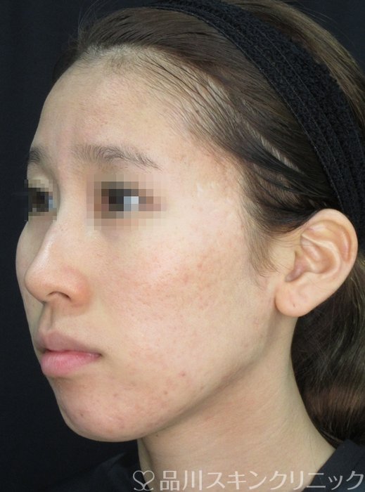 症例NO.72056のAFTER写真