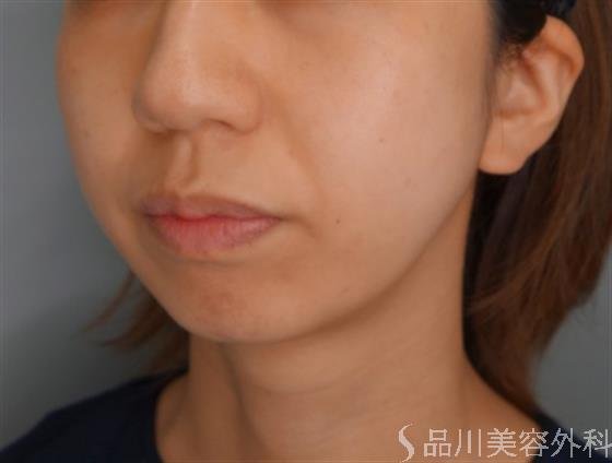症例NO.54720のBEFORE写真