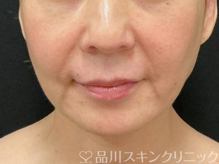 症例NO.74331のBEFORE写真