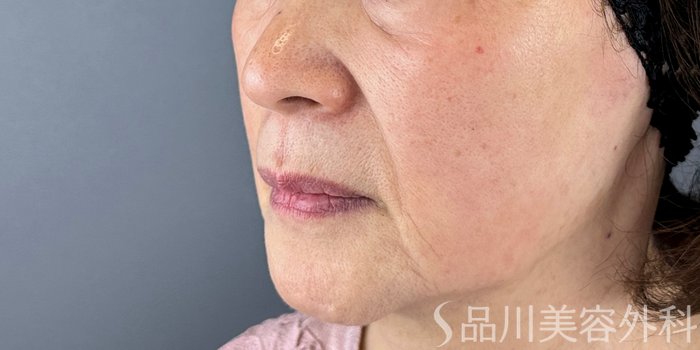 症例NO.72447のBEFORE写真