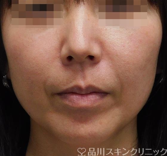症例NO.56091のBEFORE写真