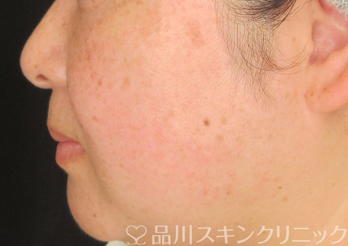 症例NO.73929のAFTER写真