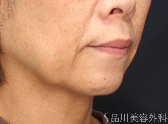 症例NO.72179のBEFORE写真