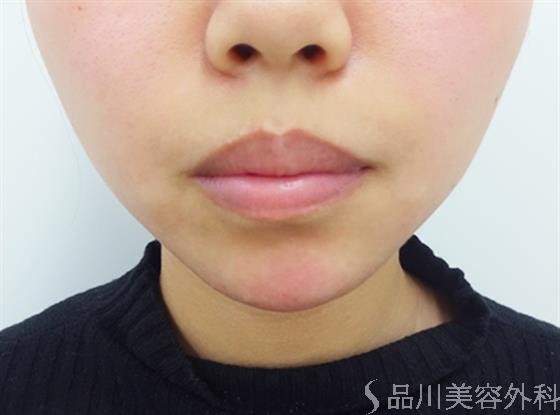 症例NO.40864のAFTER写真