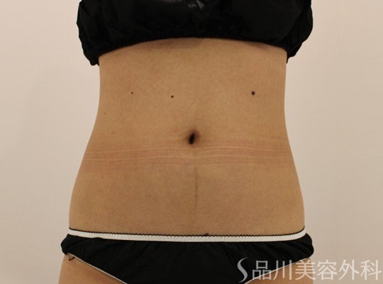 症例NO.72663のAFTER写真