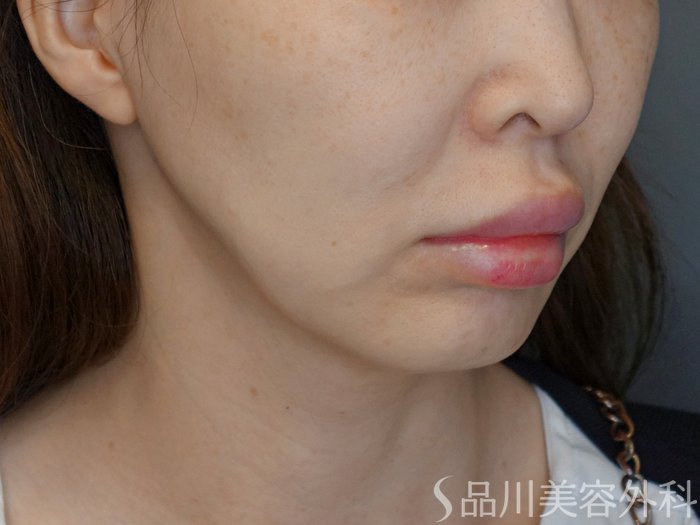 症例NO.71670のBEFORE写真