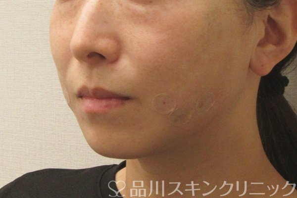 症例NO.73965のAFTER写真