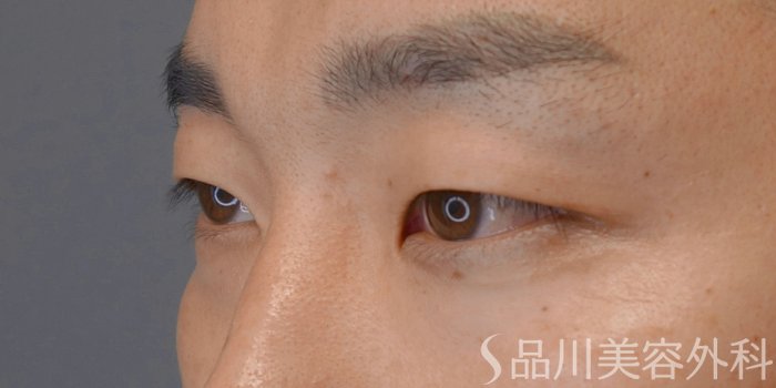 症例NO.74204のBEFORE写真