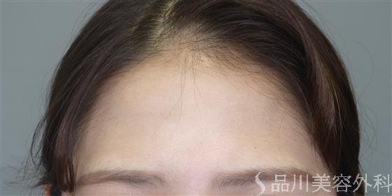 症例NO.50714のBEFORE写真