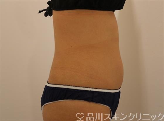 症例NO.44251のAFTER写真