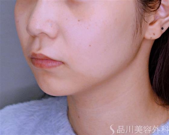 症例NO.53252のBEFORE写真
