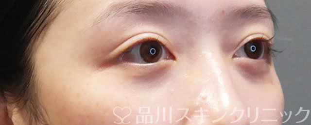 症例NO.71913のAFTER写真