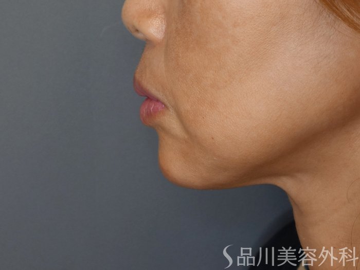 症例NO.71308のAFTER写真