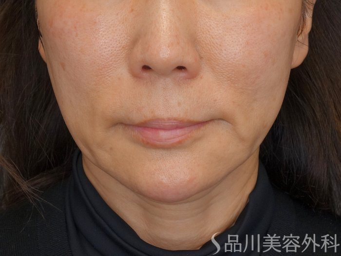 症例NO.72893のBEFORE写真