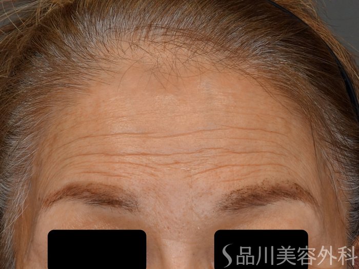 症例NO.74157のBEFORE写真