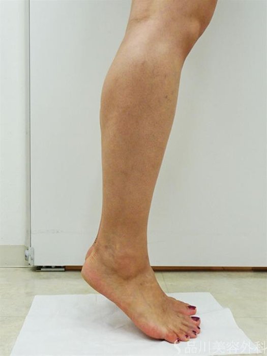 症例NO.44170のBEFORE写真