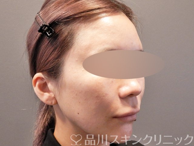 症例NO.67863のAFTER写真