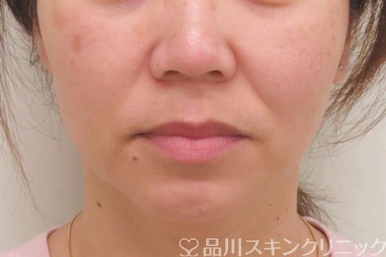 症例NO.47249のBEFORE写真