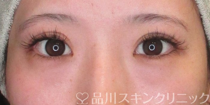 症例NO.73550のBEFORE写真