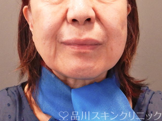 症例NO.71190のBEFORE写真