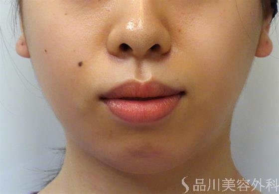 症例NO.38090のBEFORE写真