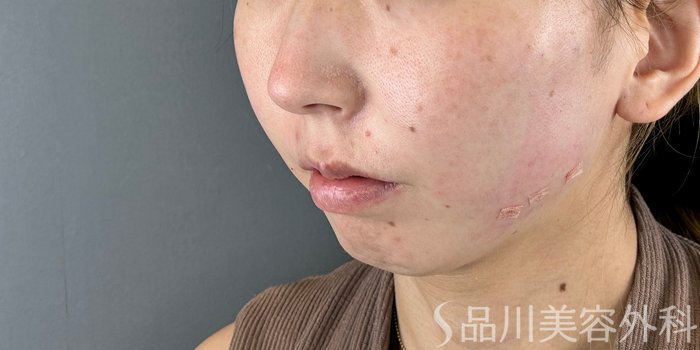 症例NO.71961のAFTER写真