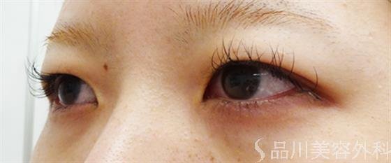 症例NO.49145のBEFORE写真