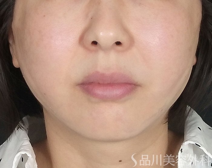 症例NO.65421のAFTER写真