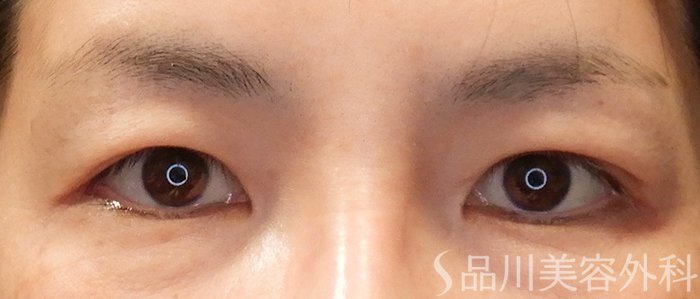症例NO.69424のBEFORE写真