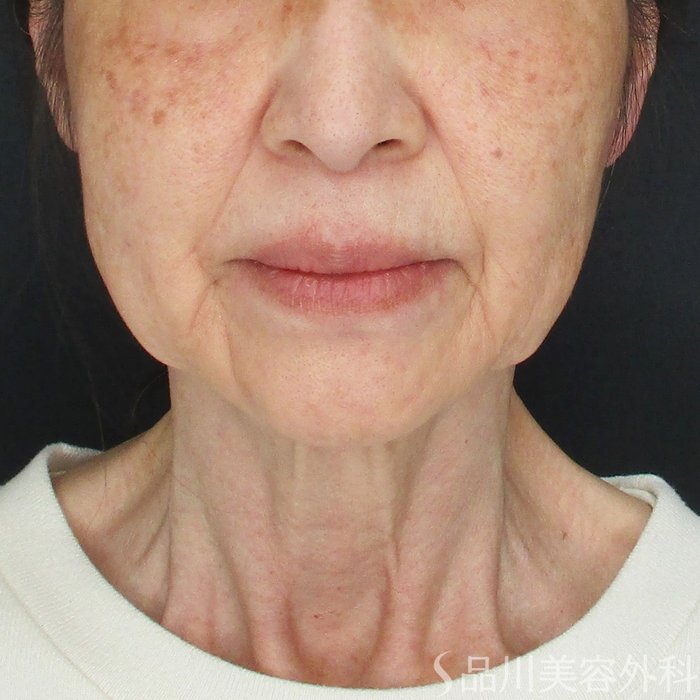 症例NO.74472のBEFORE写真