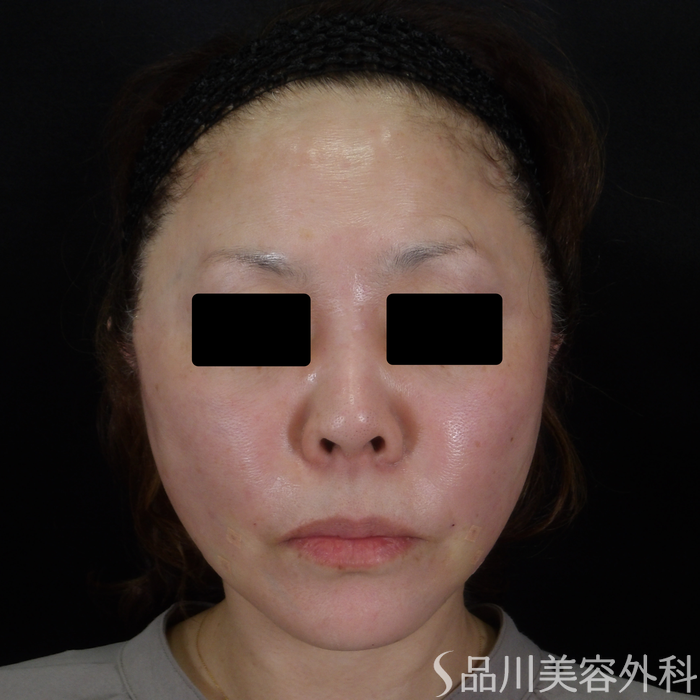 症例NO.72398のAFTER写真