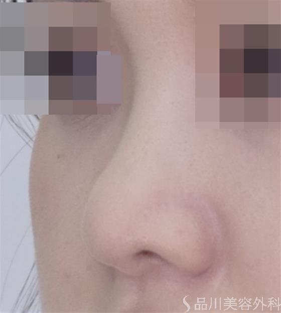 症例NO.49319のAFTER写真