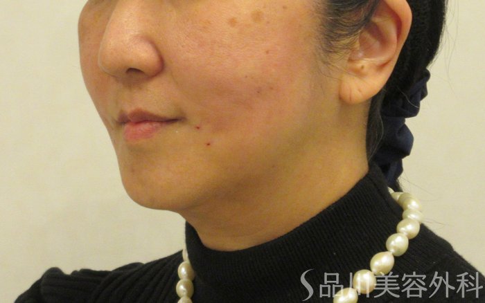 症例NO.72374のAFTER写真