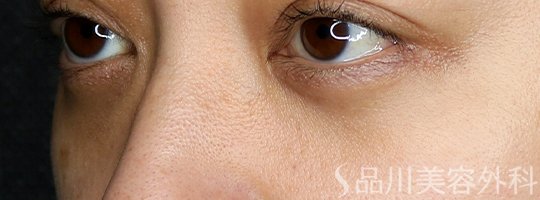 症例NO.73332のAFTER写真