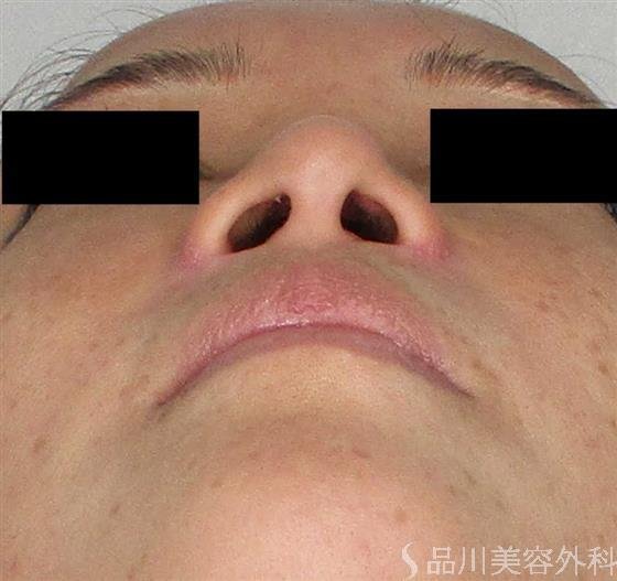 症例NO.60693のAFTER写真