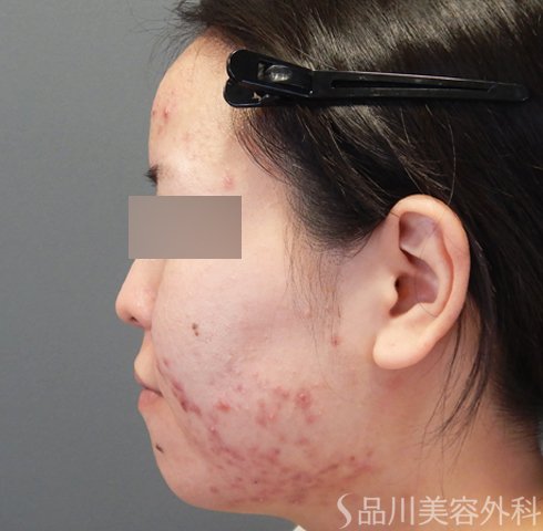 症例NO.70456のBEFORE写真