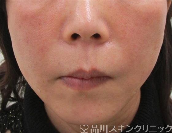 症例NO.41814のAFTER写真