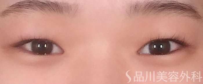 症例NO.71107のBEFORE写真
