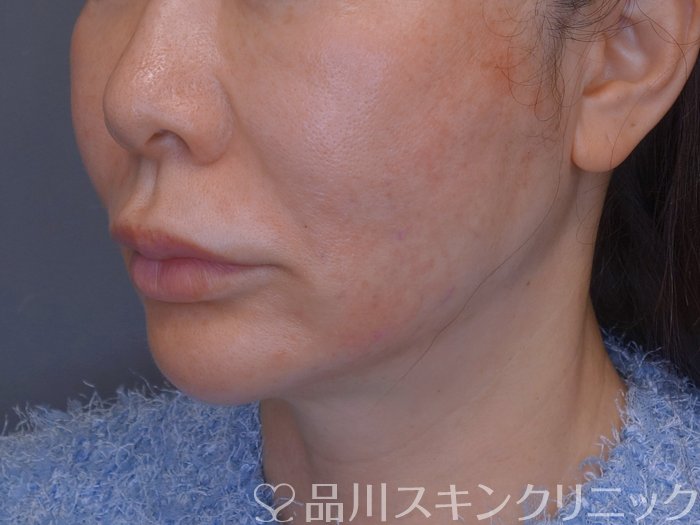 症例NO.73994のAFTER写真