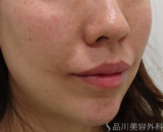 症例NO.43081のAFTER写真