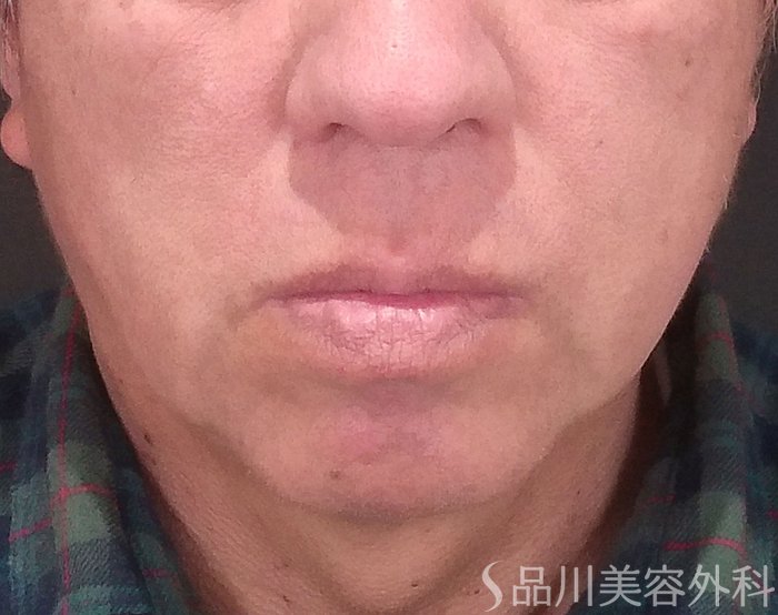 症例NO.69414のBEFORE写真