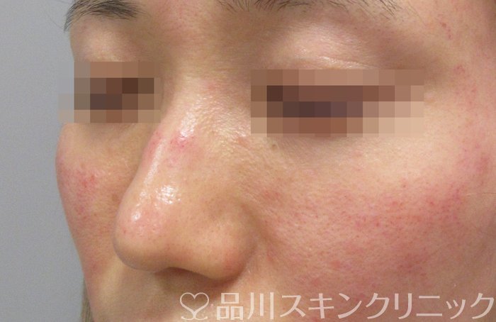 症例NO.70185のBEFORE写真