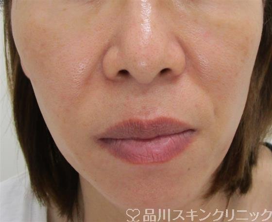 症例NO.42919のAFTER写真