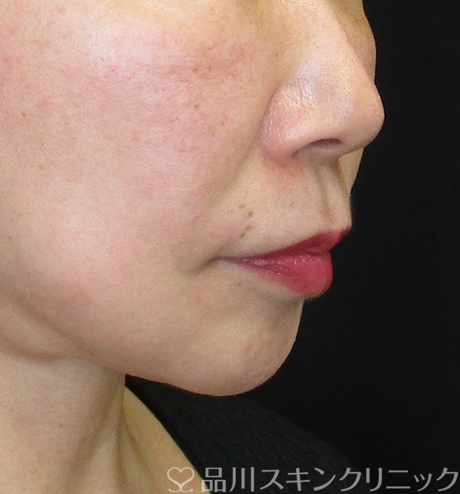 症例NO.74313のBEFORE写真