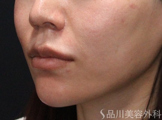症例NO.74949のAFTER写真