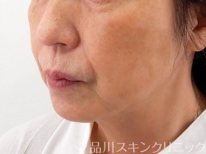 症例NO.62187のAFTER写真