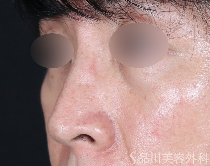 症例NO.71854のBEFORE写真