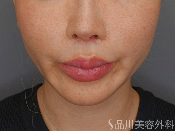 症例NO.71671のBEFORE写真