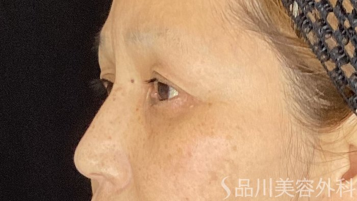 症例NO.69473のBEFORE写真