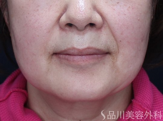 症例NO.74875のBEFORE写真